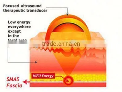 2016 FU4.5-4S Portable Hifu/hifu High Intensity Focused Ultrasound photo-4