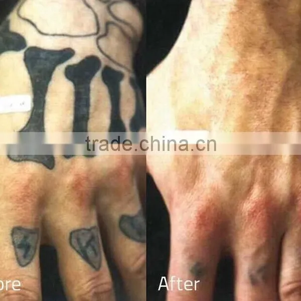 Tattoo Removal Laser Machine ND YAG 2017 Q-Swith Laser Tattoo 0.5HZ Removal Machine For Sale Telangiectasis Treatment photo-5