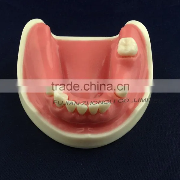 Medical Science Dental Implant Model With Soft Gingiva photo-4