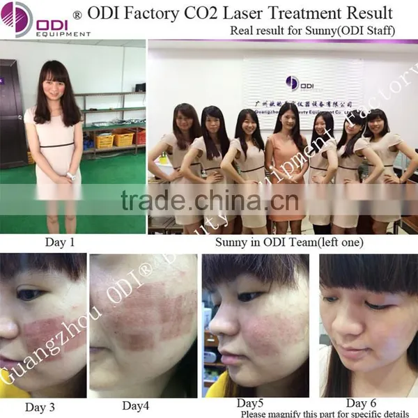 35%OFF! New Laser Co2 Fractional for Wrinkle Removal and Skin Resurfacing photo-4
