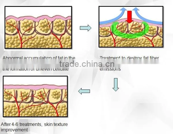 10MHz Approved Vacuum RF Liposuction Cavitation Slimming Machine Ultrasonic Cavitation System Skin Rejuvenation photo-5
