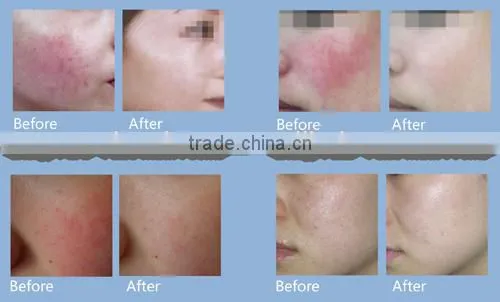 Beauty & Personal Care 980nm Diode Laser Spider Vein Removal Machine Vascular Remover photo-6