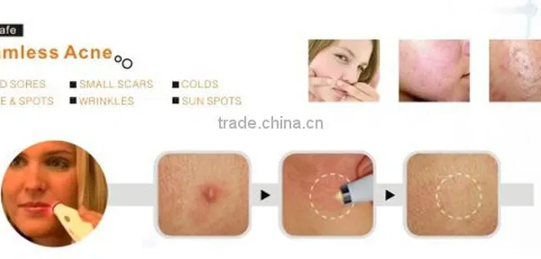Best Effective Hot Sale Soft Acne Laser Removal/acne Treatments Pen for Sale photo-5