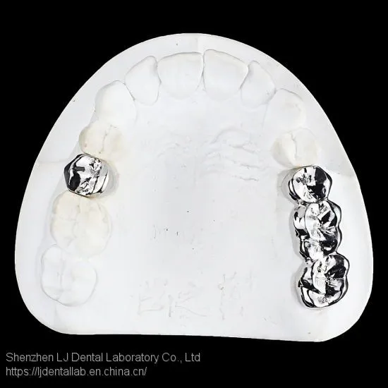 Full Metal Crown, FMC, FGC, Full Metal Post Core, Dental Crown, Cast Metal Crown, Dental Prosthesis, Laboratorio Dental, Dental Laboratory, Dentallabor, LJ Dental Lab China photo-4