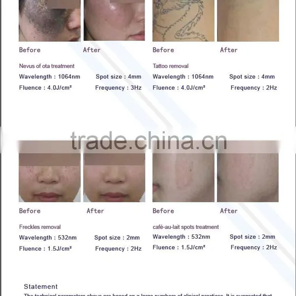 Professional Germany Laser Tan Removal Machine/skin Type Mongolian Spots Removal Vertical Nd Yag Laser Hair Removal Machine Q Switched Nd Yag Laser Tattoo Removal Machine photo-5
