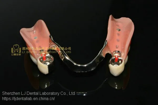 Dental Attachment, TK1 Precision Attachment, Dental Denture, Laboratoire Dentaire, Dentallabor, Laboratorio Dental, Dental Laboratory, Shenzhen LJ Dental Lab China
