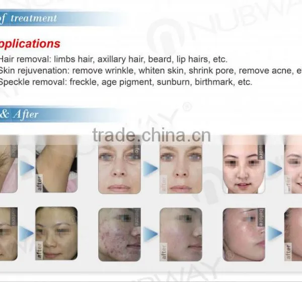 SHR IPL Elight Acne Scar Removal Machine/ Home Permanent Hair Removal photo-4