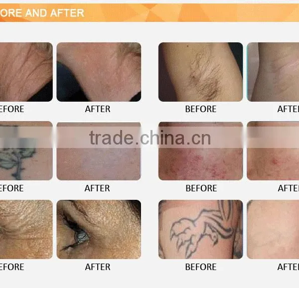 Lips Hair Removal Promotion High Frequency Ipl Handle Remove Diseased Telangiectasis Home Laser Hair Removal Machine For Acne Treatment Face Lifting photo-6