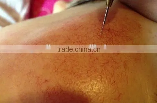 Facial Vascular Removal 30MHz Spider Vein Removal Machine photo-6