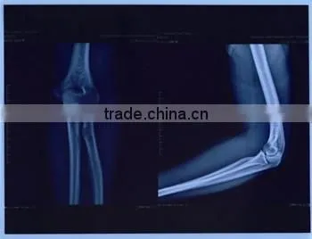 Hot Blue Film Free Blue Thermal Film Medical(12*14) X-ray Blue Film photo-6