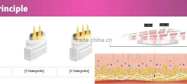 Portable Hifu Wrinkle Removal Hifu For 5.0-25mm Facial Beauty&salon Machine Without Vertical Stand Expression Lines Removal photo-5