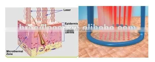 100um-2000um Vaginal Rejuvenation Vaginal Rejuvenation Laser Fractional Skin Resurfacing Co2 Gynecology Therapy Machine Treat Telangiectasis photo-5