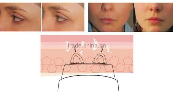 rf Treatments Ultrasound Skin Tightening Care Equipment photo-6