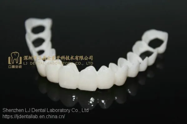 CAD/CAM PMMA Resin Clip on Veneers, Snap-on-veneers, Smile Veneers, Laboratoire Dentaire, Dentallabor, Laboratorio Dental, Dental Laboratory, Shenzhen LJ Dental Lab China photo-3