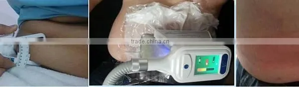 Express Cryolipolysis Fat Freezing Slimming Machine/cryolipolysis Weight Loss Weight Loss/slim Freezer Weight Loss/fat Freeze Belt Body Slimming photo-5