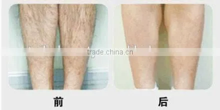 Professional Portabel Big Spot Size Epilation IPL Laser Hair Removal Machine for Beauty Salon Spa Clinic photo-6