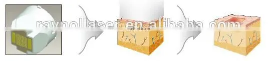 Fractional RF Microneedle for Face Lift Skin Rejuvenation Treatment photo-5