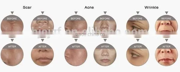 Freckle and Nevus Removal Machine From Beijing Anybeauty Company photo-6