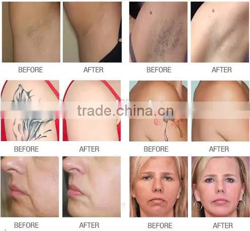 Sales Discount Diode Ipl Hair Removal Facial Whitening Multifunctional Machine photo-5