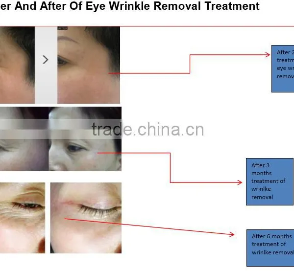 Beauty Machine Eye Care System for Eye Bag Removal for Wrinkle Removal photo-5
