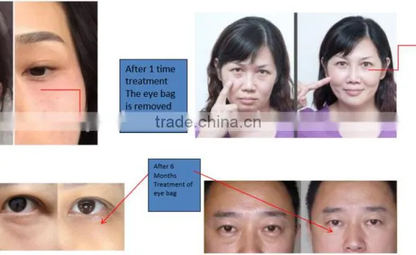 Eye Beauty Device for Removing Eye Wrinkle ,eye Bag photo-6