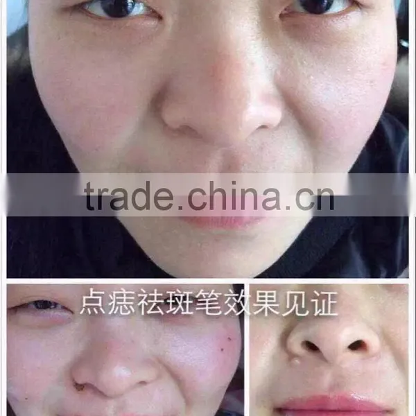 Spot Removal Machine , Freckle Removal Machine $260/pcs ,without Shipping photo-3