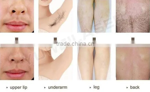 Fine Lines Removal Wholesale Price Multifunctional Medical E-light Ipl And Rf For Hair Removal photo-6