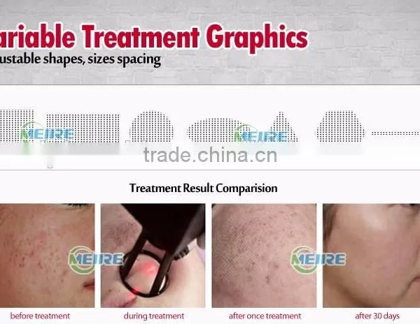 Factory Price CE Approved Fractional Co2 Laser Scar Removal High Quality Fractional Co2 Laser photo-4