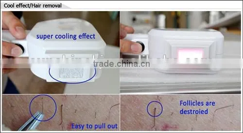 2015 New Multi-function 2 in 1 Alexsandrite Laser Hair Removal With 808 System photo-4