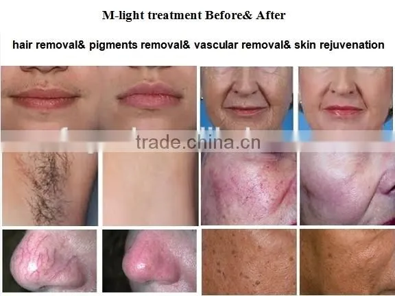 Super Hair Removal Machine With IPL SHR Elight OPT From Beijing Fogool photo-5