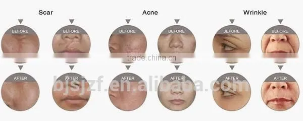Wrinkle Removal Vertical F7 Co2 Fractional Laser For 8.0 Inch Wrinkle Spot Scar Pigment Removal Equipment/medical Fractional Co2 Laser photo-6