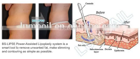 Vaser Tumescent Liposuction Machine photo-2