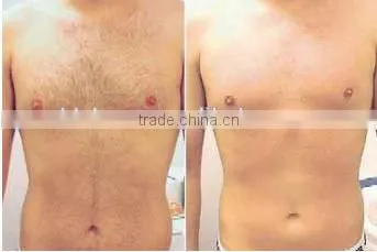 Permanent 808nm Diode Laser Bode Hair Removal With No Pain Arm / Chest Hair Removal photo-4