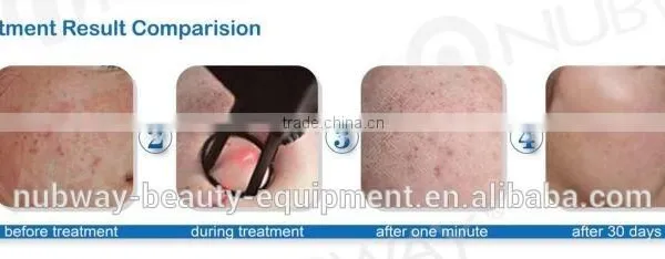 RF Pipe Fractional Co2 Carboxytherapy Laser Vaginal Tightening Machine Treat Telangiectasis photo-4