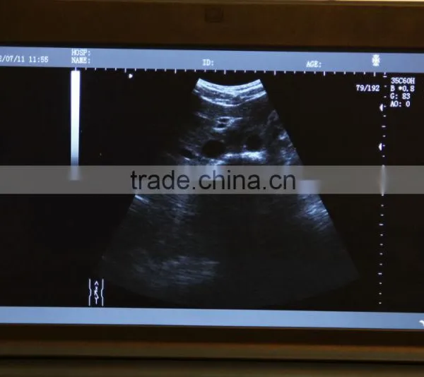 Clear Image Laptop Type Ultrasound Scanner System Full Digital Machine in Transport Carriage photo-3
