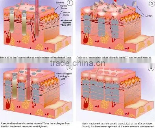 Portable 40W RF Tube Pixel Co2 Fractional Laser With Virginal Tightening photo-4