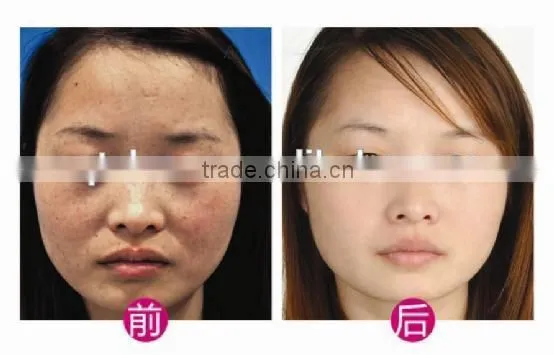 1 HZ Q Switch Nd Yag Laser Tattoo Q Switch Laser Machine Removal Skin Rejuvenation Machine Tattoo Laser Removal Machine photo-3