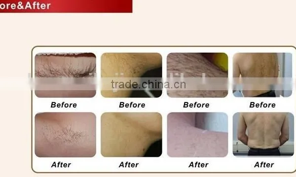 Skin Lifting Professional Ipl Hair Removal And Facial Rejuvenation Machine Hair Removal photo-2