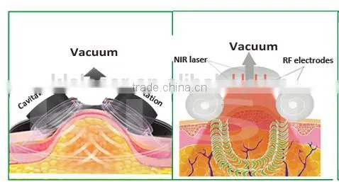 High Frequencyfat Burning Newest Big Fat Cavitation Machine Promotion Cavitation Machine/ultrasonic Cavitation/cavitation Slimming Machine Ultrasonic Liposuction Machine photo-3