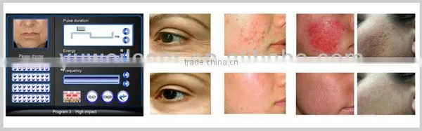 2015 Most Popular Fractional rf Beauty Device for All Kinds Wrinkle Remomal photo-5