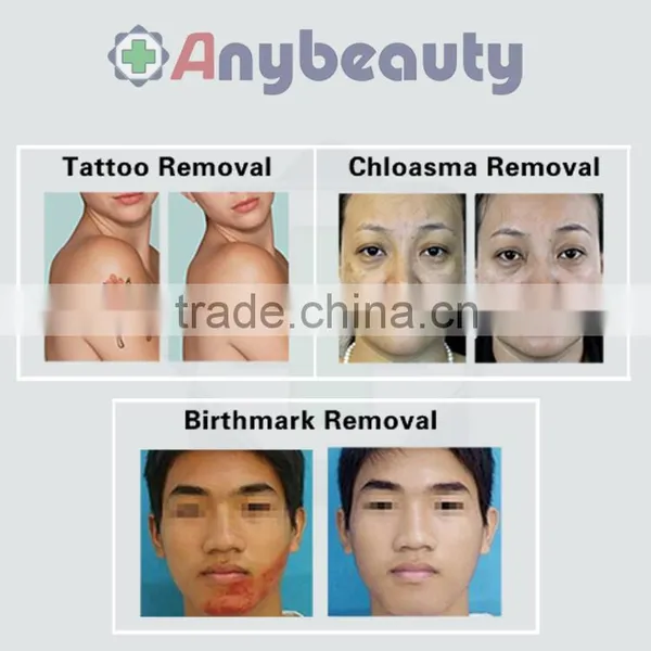 Haemangioma Treatment Professional Nd Yag Laser 532nm Beauty Machine New Laser For Tattoo Removal photo-3