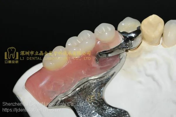 Dental Precision Attachment, Dental Attachment, Dental Denture, Laboratoire Dentaire, Dentallabor, Laboratorio Dental, Dental Laboratory, Shenzhen LJ Dental Lab China photo-4