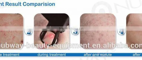 Ultra Pulse Pigmentation Removal CO2 Laser Resurfacing Machine photo-5