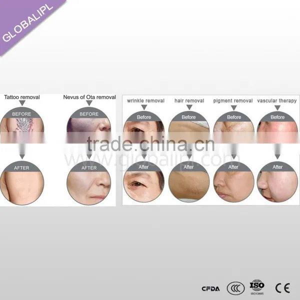 High Quality Skin Rejuvenation Hair Removal 2H Ipl Elight photo-6