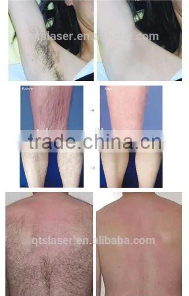 QTS Alexandrite Laser Hair Removal Machine Price With CE photo-5