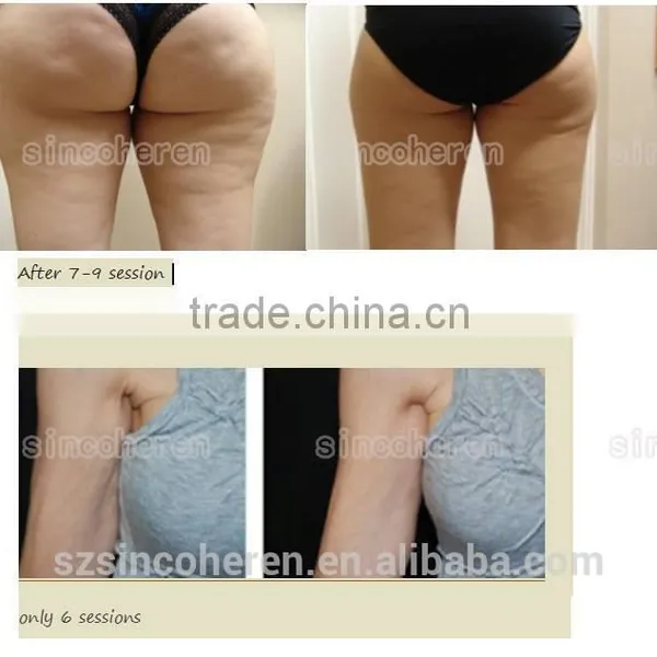 Ultrasonic Vacuum RF Kuma Body Slimming Body Contouring Machine photo-5