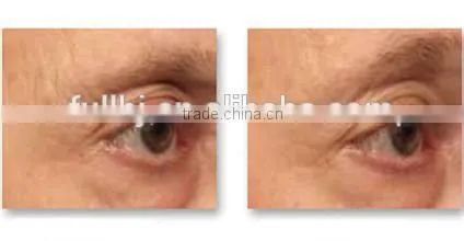 2015 New Arrival Monopolar RF Radio Frequency Tighten Wrinkle photo-4