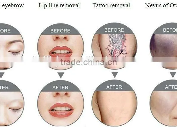 Portable Tattoo Removal Machine photo-3