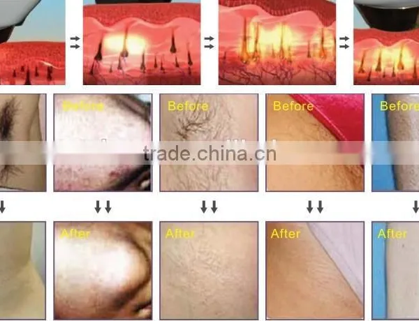 Latest Technology 808nm Diode Laser Professional Hair Removal Machine photo-6