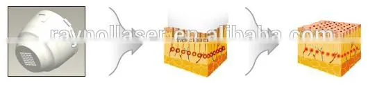 New Fractional RF Microneedle for Face Lift , Facial Acne Scar Treatment photo-6